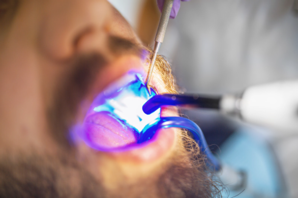 tooth filling your gold coast dentist