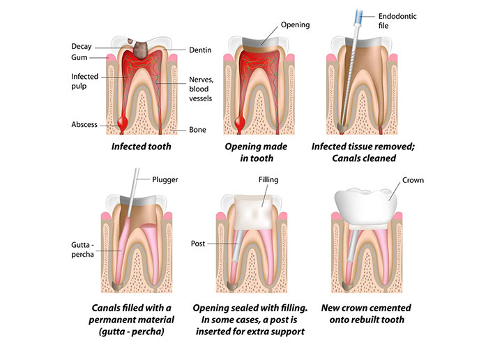 Root Canal Treatment blog image